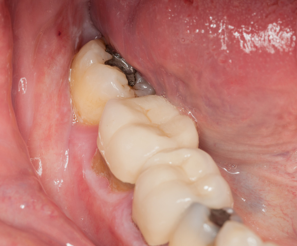 a close up image of mouths interior with tooth decay