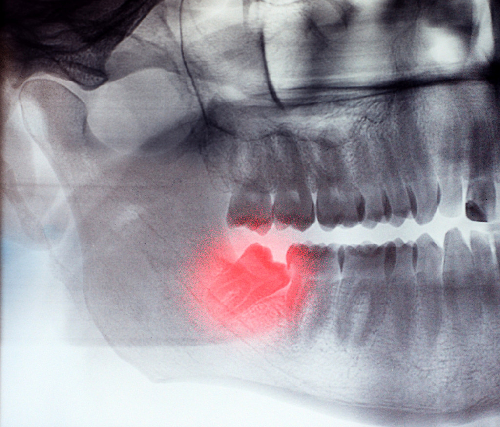 an xray report of impacted wisdom tooth 
